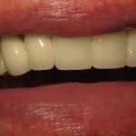 smile gallery after photo