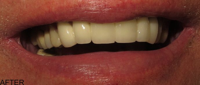 smile gallery after photo