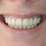 smile gallery after photo