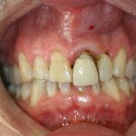 smile gallery before photo