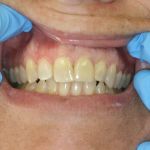 smile gallery after photo