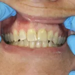 smile gallery after photo
