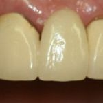 smile gallery before photo