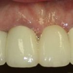 smile gallery after photo