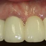 smile gallery after photo