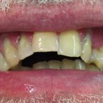 smile gallery before photo