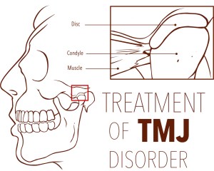 Diagram showing the anatomy of the human jaw referring to TMJ disorder